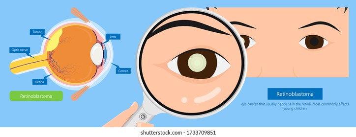 Retinoblastoma blind ophthalmologist retinocytoma ophthalmology anatomy cornea squint