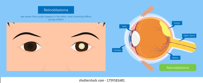 Retinoblastoma blind ophthalmologist retinocytoma ophthalmology anatomy cornea squint