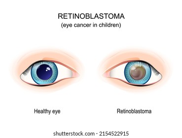 Retinoblastoma. Augenkrebs bei Kindern. Vergleich von gesundem Auge und Leukokoria. Auge mit erblicher genetischer Störung. Vektorgrafik