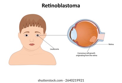  Retinoblastoma on the eye vector illustration