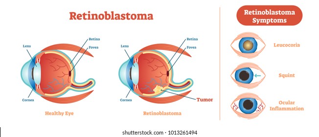 Retinoblastoma vector illustration diagram, anatomical scheme. Medical educational information. 