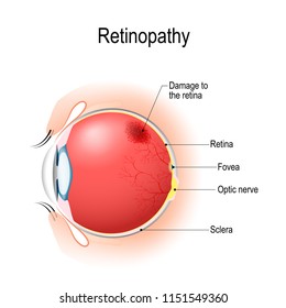 Retinopathy is damage to the retina of the eyes, which cause vision impairment. Anatomy of the human eye. Vertical section of the eye and eyelids. Schematic diagram. detailed illustration.
