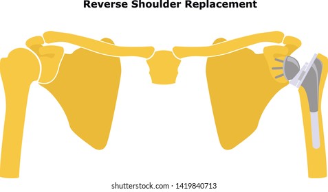 Reverse Shoulder Replacement. Shoulder joint replacement, endoprosthetics. Osteoarthrosis of the shoulder joint. Vector illustration. Flat design.