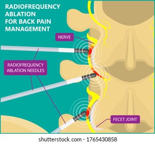 899 Neuropathic Pain Images, Stock Photos & Vectors | Shutterstock