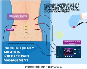 RFA low arm leg hip pain back neck knee pars bone nerve treat joint spine block Local radio needle relief branch Lumbar spinal damage pelvis therapy lateral chronic vertebra cervical surgical medial