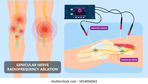 RFA low arm leg hip pain back neck knee pars bone nerve treat joint spine block Local radio needle relief branch Lumbar spinal damage pelvis therapy lateral chronic vertebra cervical surgical medial