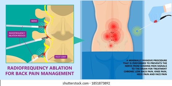 RFA low arm leg hip pain back neck knee pars bone nerve treat joint spine block Local radio needle relief branch Lumbar spinal damage pelvis therapy lateral chronic vertebra cervical surgical medial