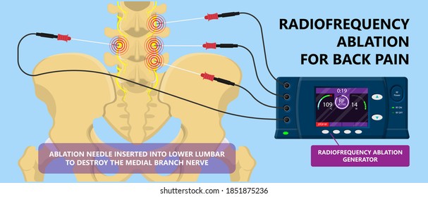 RFA low arm leg hip pain back neck knee pars bone nerve treat joint spine block Local radio needle relief branch Lumbar spinal damage pelvis therapy lateral chronic vertebra cervical surgical medial