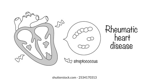 Rheumatische Herzkrankheit. Eine Erkrankung, bei der eine Herzentzündung mit Rheuma in Verbindung gebracht wird. Verdickung des Herzmuskels und Streptokokkeninfektion im Herzmuskel.