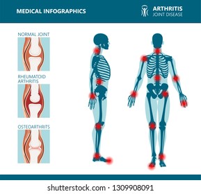 Rheumatism or rheumatic disorder medical posters. Arthritis joint pain syndrome. Major rheumatic disorders as back, neck pain, Capsulitis or rheumatoid arthritis. Rheumatology vector infographics