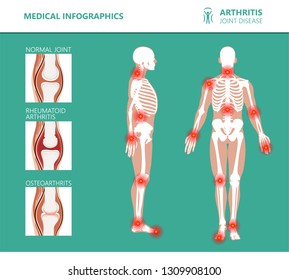 Rheumatism or rheumatic disorder medical posters. Arthritis joint pain syndrome. Major rheumatic disorders as back, neck pain, Capsulitis or rheumatoid arthritis. Rheumatology vector infographics