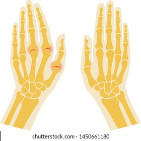 Rheumatoid arthritis bone hand. Palm and fingers. Vector image on white background. 