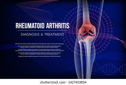 Rheumatoid arthritis Bones the of knee