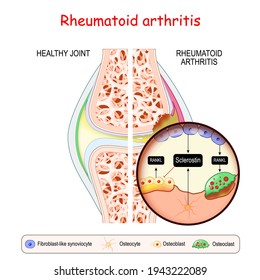 Rheumatoid arthritis. Close-up of bone cells (Osteocyte, Osteoblast, Osteoclast, and Fibroblast-like synoviocyte) that secrete RANKL and Sclerostin. comparison Healthy joint and knee with RA