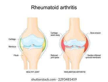 Rheumatoid arthritis. A comparison between a healthy knee and joint with Bone erosion, Cartilage wears, Reduced joint space and Swollen inflamed synovial membrane. Vector illustration 