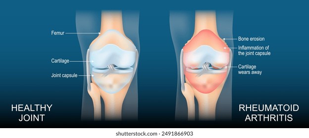 Rheumatoid arthritis. A comparison between a healthy knee and joint with Bone erosion, Cartilage wears, Reduced joint space and Swollen inflamed synovial membrane. Diagnostic images to aid patient