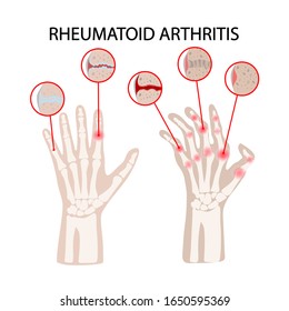 12,229 Rheumatoid arthritis hands Images, Stock Photos & Vectors ...