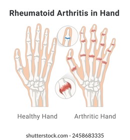 Rheumatoid arthritis of finger joint with details of hand bone anatomy medical poster isometric vector illustration. Healthcare medicine human disease normal and inflammation orthopedic skeleton pain