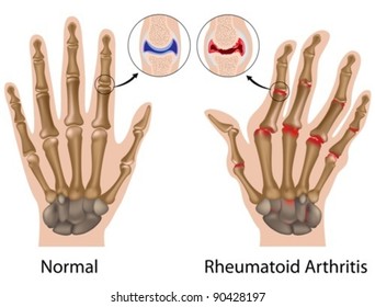 Rheumatoid Arthritis Of Finger Joint With Details Of Hand Bone Anatomy