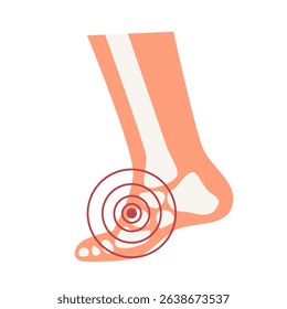 Rheumatoid arthritis foot joint pain illustration. World Arthritis Day concept