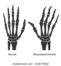 Rheumatoid arthritis of the hands. Black silhouettes isolated on white background. Vector illustration