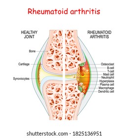 Rheumatoid Arthritis. Healthy And Damage Joint. Close-up Of Bone, Cartilage, And Cells In A Joint Capsule: Synoviocytes, Osteoclast, Neutrophil, T Lymphocyte, B-cell, Macrophage,  Mast Cell  