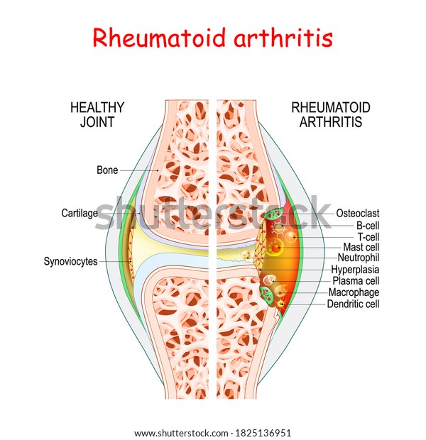 Rheumatoid Arthritis Healthy Damage Joint Closeup Stock Vector (Royalty ...