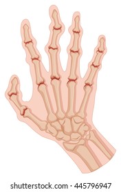 Rheumatoid arthritis in human hand illustration