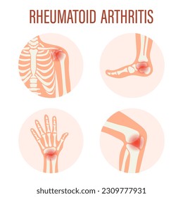 Rheumatoid arthritis icons. Knee joint, shoulder joint, wrist joint, foot joint. Types of arthritis. Medical concept. Vector