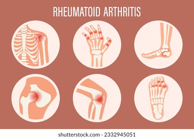 Rheumatoid arthritis icons. Knee joint, shoulder joint, wrist joint, hip joint, foot. Types of arthritis. Medical concept. Vector