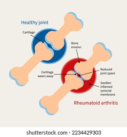 Rheumatoid arthritis illustration. Auto immune disease, inflammatory type of arthritis