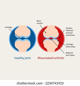 Rheumatoid arthritis illustration. Auto immune disease, inflammatory type of arthritis