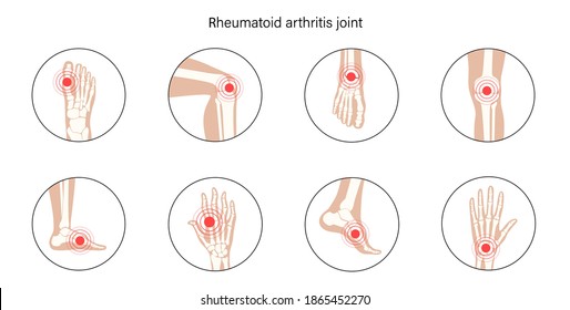 Rheumatoid Arthritis, Inflammation, Bone Disease Concept. Set With Spine, Knee, Wrist And Other Joint Icons For Clinic. Pain In The Human Body, Anatomical Medical Poster. Xray Flat Vector Illustration