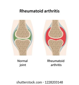 Rheumatoid arthritis of the joint. Image of healthy joint and diseased joint isolated on white background. Vector illustration
