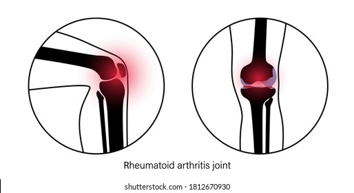 Rheumatoid arthritis knee joint icon. Clinic logo with pain in leg. Human bone anatomy flat vector illustration. Skeleton x ray scan concept. Painful injury erosion on medical poster for hospital.