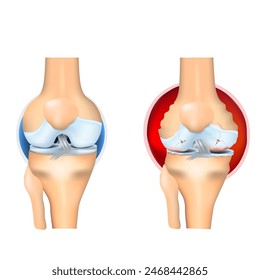 Rheumatoid Arthritis of knee joint. RA is an inflammatory type of arthritis. Autoimmune disease. Erosive arthritis. Vector illustration.