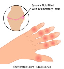 Rheumatoid arthritis on  fingers  medical vector illustration on a white background