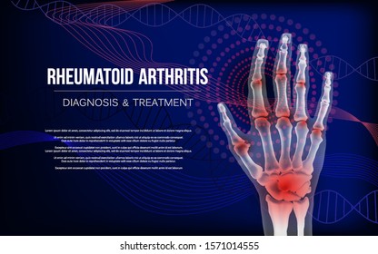 Rheumatoid arthritis osteoarthritis banner inflammation joints of bones of hand.
