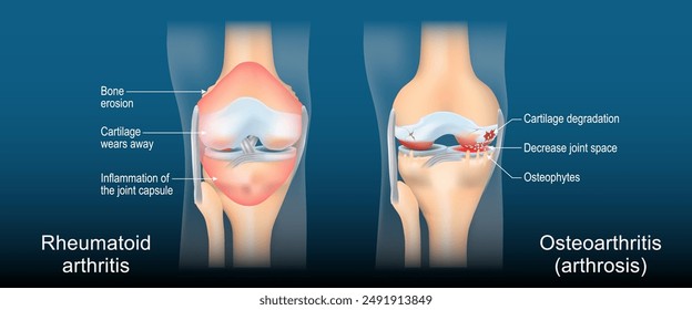 Rheumatoid arthritis and Osteoarthritis. Comparison between a Arthrosis and RA joint. Diagnostic images to aid patient and doctor. Realistic transparent blue joint on dark background. Vector