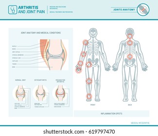 Rheumatoid arthritis, osteoarthritis and joint pain infographic with inflammation spots and anatomical illustration