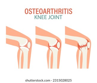 Rheumatoid arthritis. Osteoarthritis of the knee joints. Medical concept. Infographic poster, banner, vector