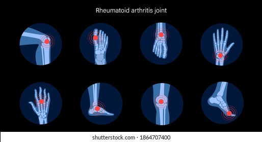 Rheumatoid arthritis, pain, bone disease concept. Set with spine, knee, ankle and other joint icons. Inflammation in parts of the human body, anatomical medical poster. Xray flat vector illustration.