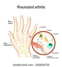 Rheumatoid Arthritis (RA) is an auto immune disease and inflammatory type of arthritis that usually affects joints. hand with rheumatoid arthritis 