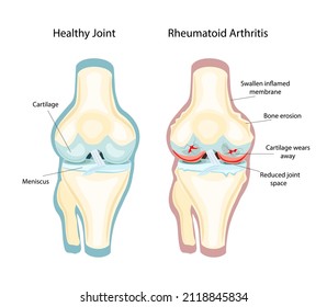 Rheumatoide Arthritis RA ist eine entzündliche Art von Arthritis, die gewöhnlich die Knie betrifft. rheumatoide Arthritis rheumatoide Arthritis rheumatoide Arthritis rheumatoider Arthritis, die gewöhnlich die Knie betrifft.Vektorgrafik
