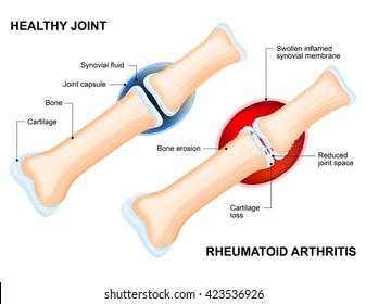 Rheumatoid Arthritis (RA) Is An Inflammatory Type Of Arthritis That Usually Affects Joint. Auto Immune Disease.