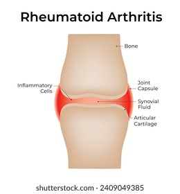 Rheumatoid Arthritis Science Design Vector Illustration