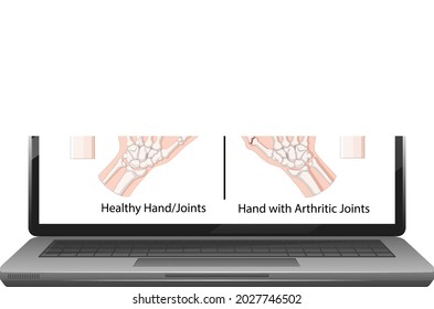 Rheumatoid arthritis symptoms on hand on laptop screen illustration