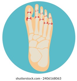 Rheumatoid arthritis of the toes. Arthritis of the leg. Medicine education. Anatomy of joints and bones. Vector illustration
