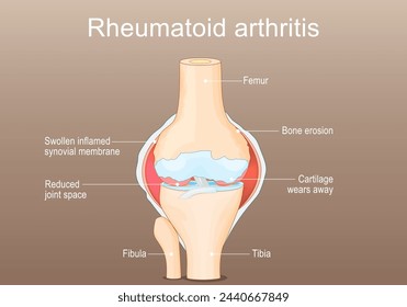 Rheumatoid Arthritis RA. Inflammatory type of arthritis that affects of knee. Auto immune disease. The immune system mistakenly attacks healthy joint tissue. Joint deformity. Isometric Flat vector