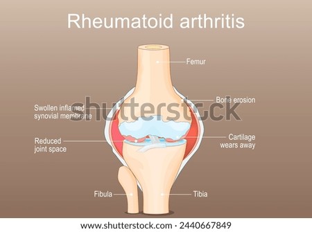 Rheumatoid Arthritis RA. Inflammatory type of arthritis that affects of knee. Auto immune disease. The immune system mistakenly attacks healthy joint tissue. Joint deformity. Isometric Flat vector